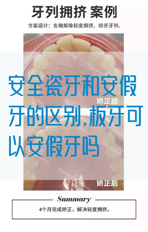安全瓷牙和安假牙的区别,板牙可以安假牙吗(图1)
