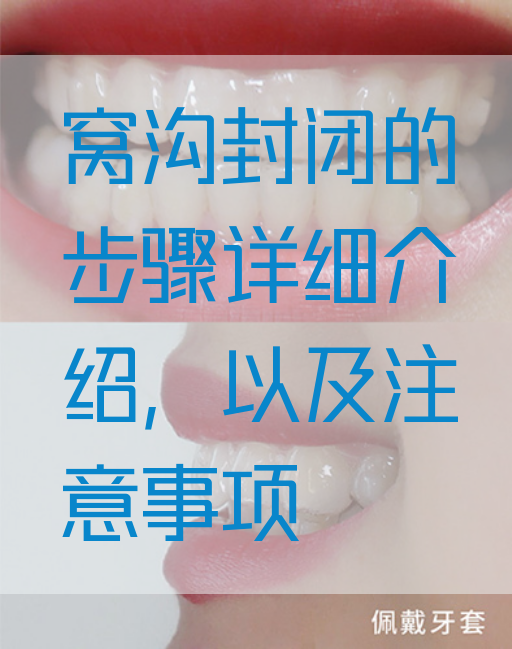 窝沟封闭的步骤详细介绍，以及注意事项(图1)