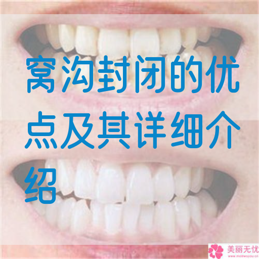 窝沟封闭的优点及其详细介绍(图1)