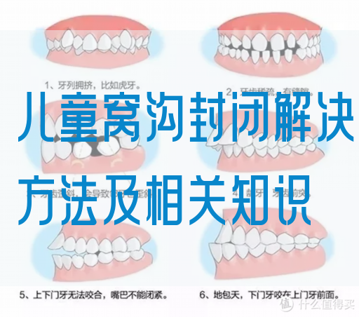 儿童窝沟封闭解决方法及相关知识(图1)