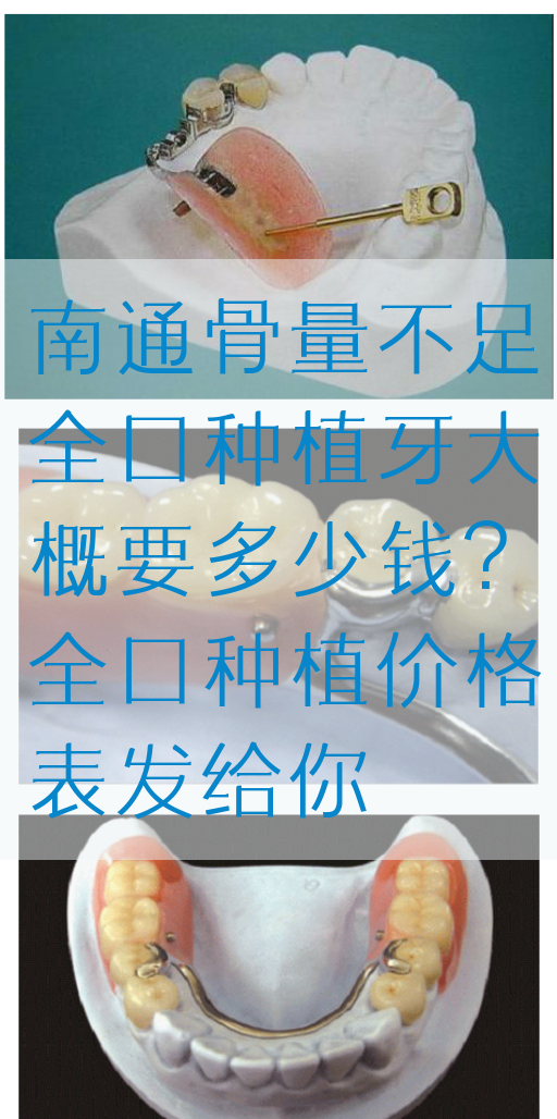 南通骨量不足全口种植牙大概要多少钱?全口种植价格表发给你