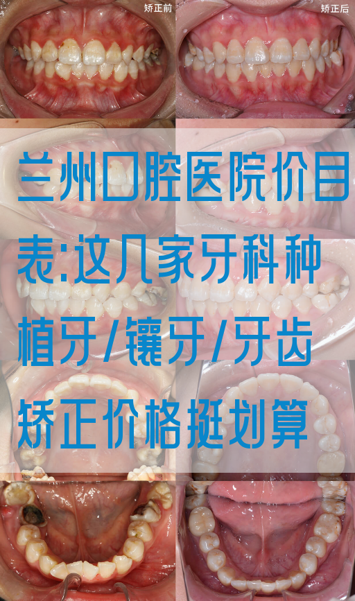 兰州口腔医院价目表:这几家牙科种植牙/镶牙/牙齿矫正价格挺划算