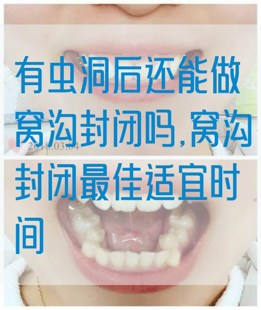 有虫洞后还能做窝沟封闭吗,窝沟封闭最佳适宜时间(图1)