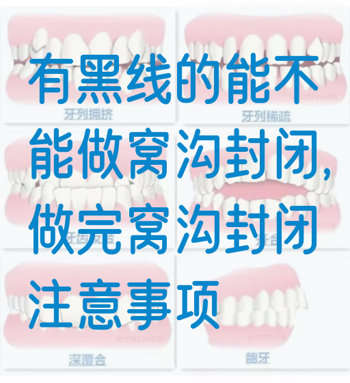 有黑线的能不能做窝沟封闭,做完窝沟封闭注意事项(图1)