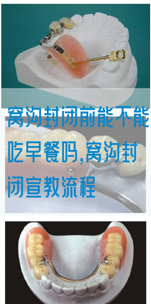 窝沟封闭前能不能吃早餐吗,窝沟封闭宣教流程(图1)
