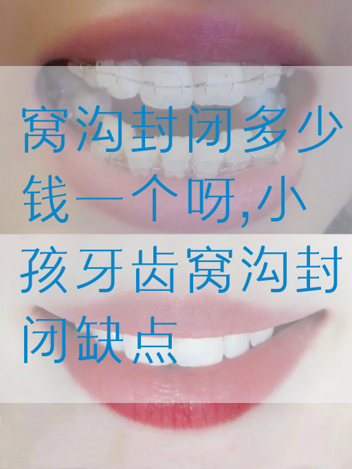 窝沟封闭多少钱一个呀,小孩牙齿窝沟封闭缺点(图1)