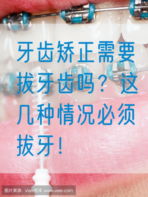 牙齿矫正需要拔牙齿吗？这几种情况必须拔牙！