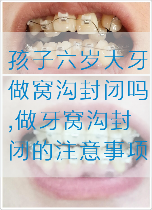 孩子六岁大牙做窝沟封闭吗,做牙窝沟封闭的注意事项