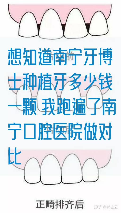 想知道南宁牙博士种植牙多少钱一颗 我跑遍了南宁口腔医院做对比