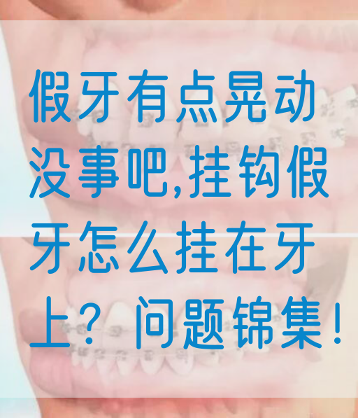 假牙有点晃动没事吧,挂钩假牙怎么挂在牙上？问题锦集！
