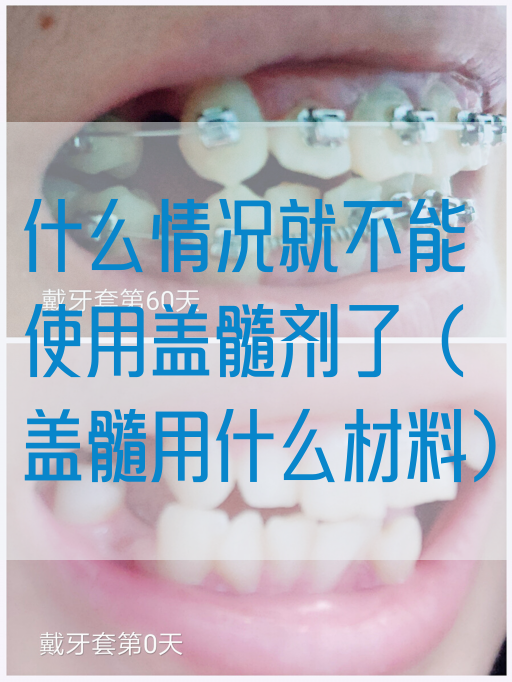 什么情况就不能使用盖髓剂了（盖髓用什么材料）(图1)