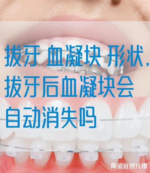 拔牙 血凝块 形状,拔牙后血凝块会自动消失吗