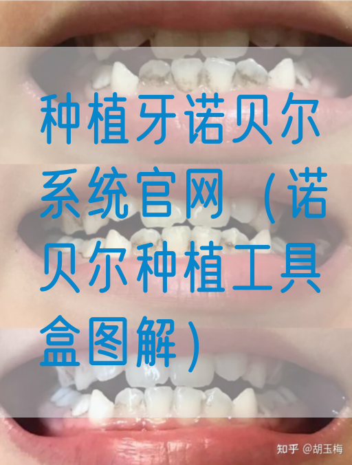 种植牙诺贝尔系统官网（诺贝尔种植工具盒图解）(图1)