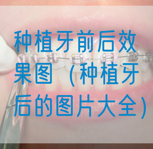 种植牙前后*（种植牙后的图片大全）(图1)