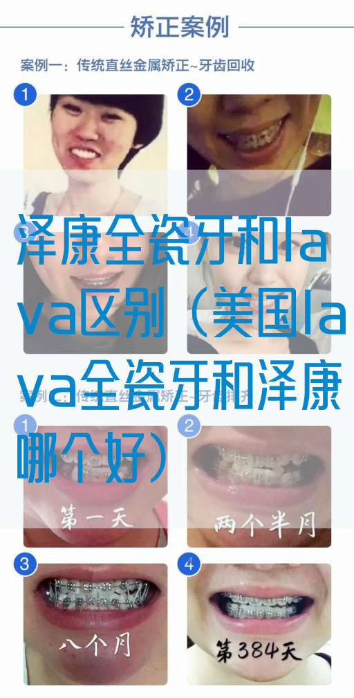 泽康全瓷牙和lava区别（美国lava全瓷牙和泽康哪个好）(图1)