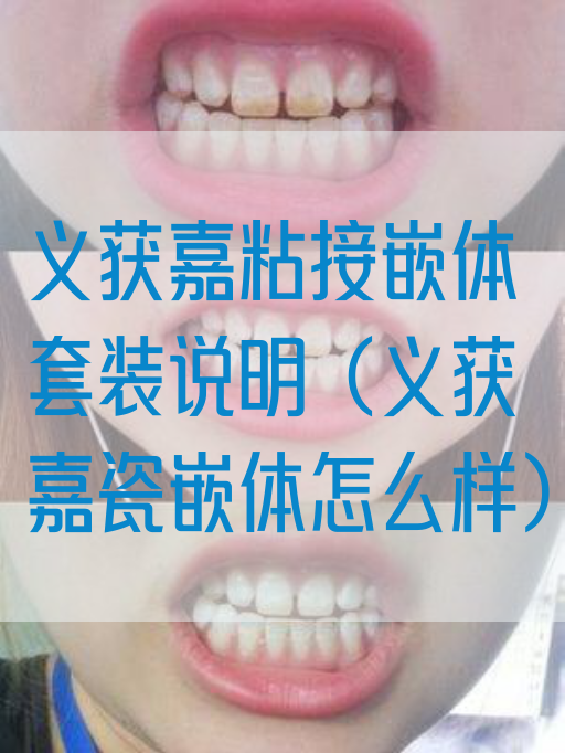 义获嘉粘接嵌体套装说明（义获嘉瓷嵌体怎么样）(图1)