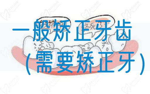 一般矫正牙齿（需要矫正牙）(图1)