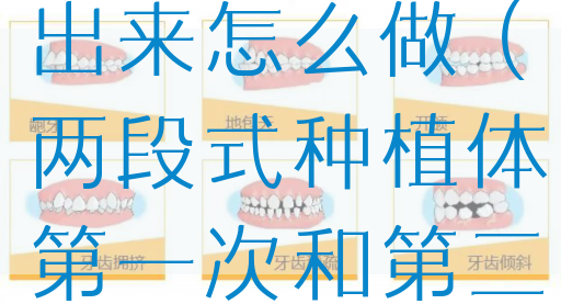 一段式植体接出来怎么做（两段式种植体第一次和第二次）(图1)