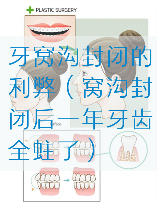牙窝沟封闭的利弊（窝沟封闭后一年牙齿全蛀了）(图1)
