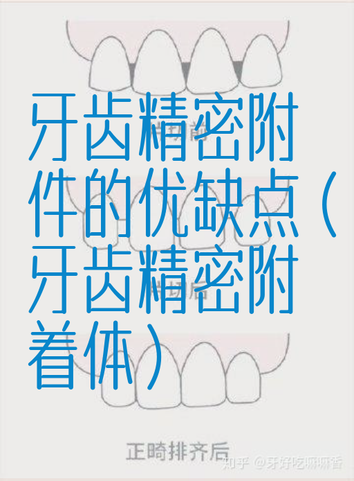 牙齿*密附件的优缺点（牙齿*密附着体）(图1)