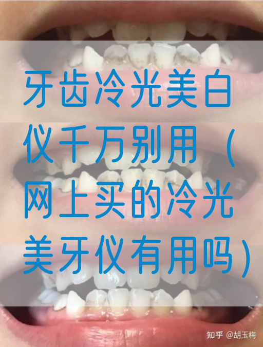 牙齿冷光美白仪千万别用（网上买的冷光美牙仪有用吗）(图1)