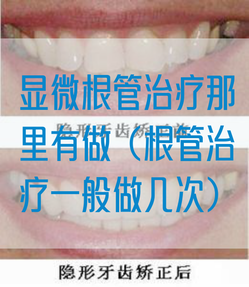 显微根管治疗那里有做（根管治疗一般做几次）(图1)