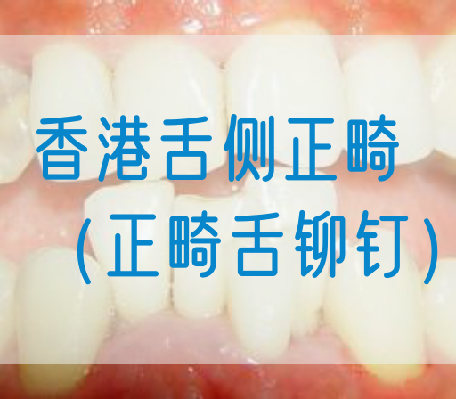 *舌侧正畸（正畸舌铆钉）(图1)