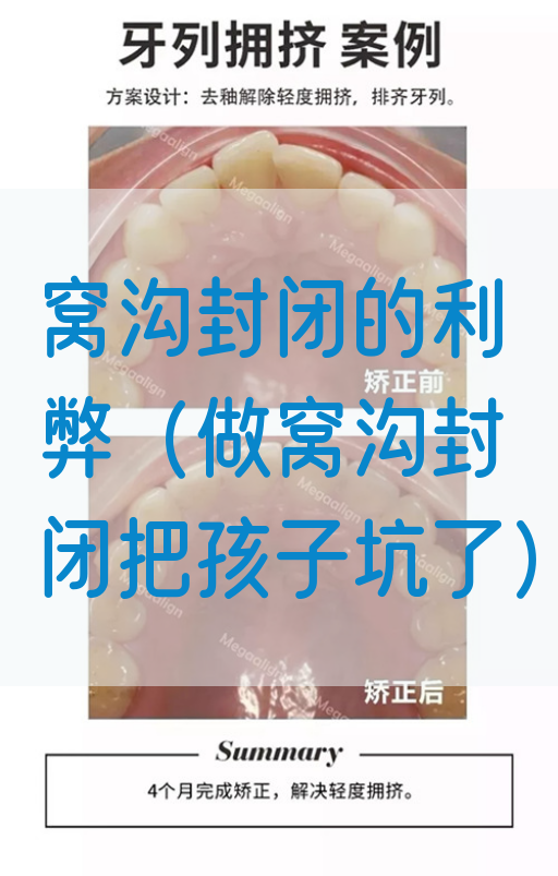 窝沟封闭的利弊（做窝沟封闭把孩子坑了）(图1)