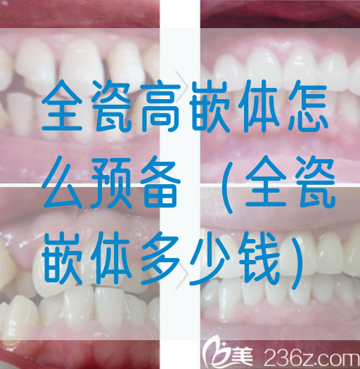 全瓷高嵌体怎么预备（全瓷嵌体多少钱）(图1)