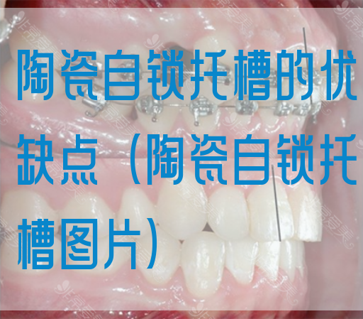 陶瓷自锁托槽的优缺点（陶瓷自锁托槽图片）(图1)