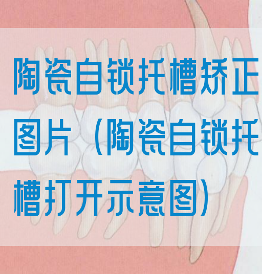 陶瓷自锁托槽矫正图片（陶瓷自锁托槽打开示意图）(图1)