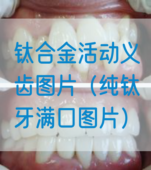 钛合金活动义齿图片（纯钛牙满口图片）(图1)