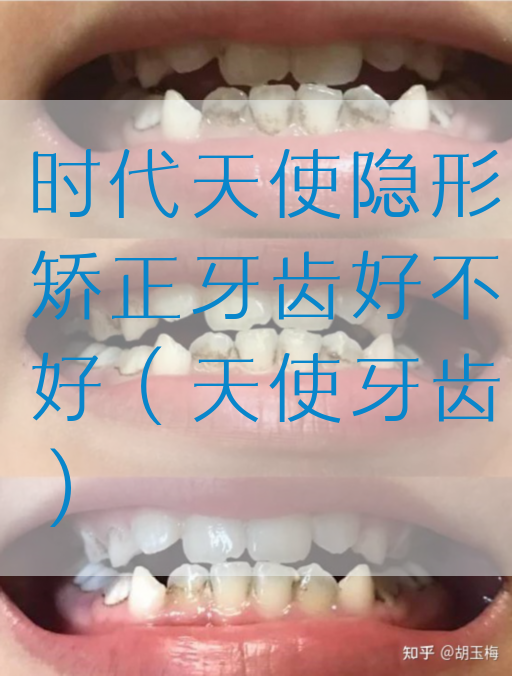 时代天使隐形矫正牙齿好不好（天使牙齿）(图1)