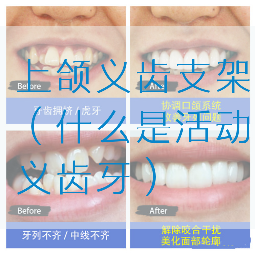 上颌义齿支架（什么是活动义齿牙）(图1)