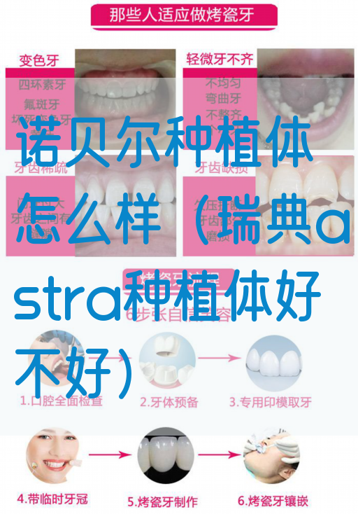 诺贝尔种植体怎么样（瑞典astra种植体好不好）(图1)