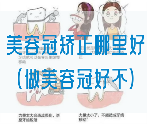 美容冠矫正哪里好（做美容冠好不）(图1)