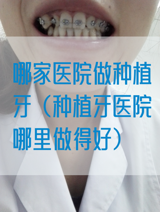 哪家医院做种植牙（种植牙医院哪里做得好）(图1)