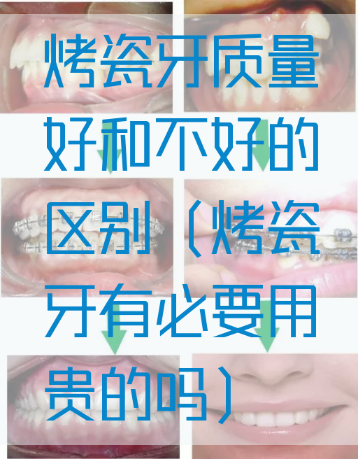 烤瓷牙质量好和不好的区别（烤瓷牙有必要用贵的吗）(图1)