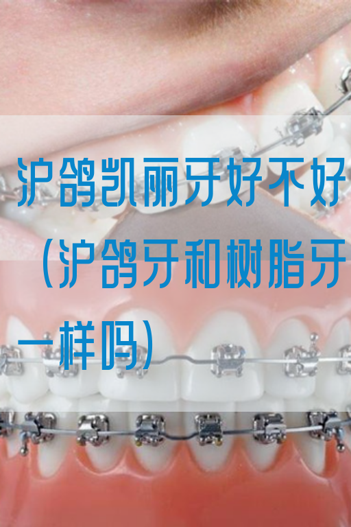 沪鸽凯丽牙好不好（沪鸽牙和树脂牙一样吗）(图1)