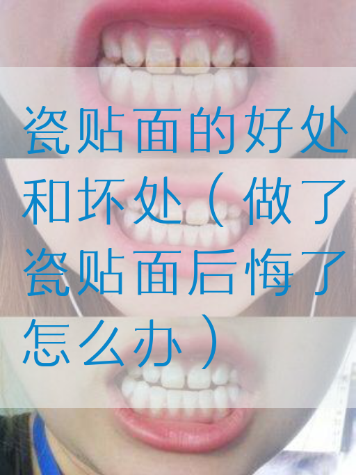 瓷贴面的好处和坏处（做了瓷贴面后悔了怎么办）(图1)