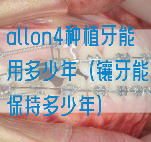 allon4种植牙能用多少年（镶牙能保持多少年）(图1)