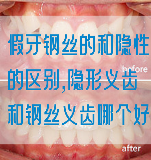假牙钢丝的和隐性的区别,隐形义齿和钢丝义齿哪个好