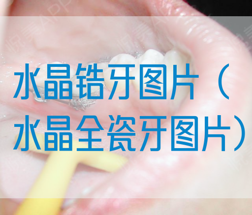 水晶锆牙图片（水晶全瓷牙图片）