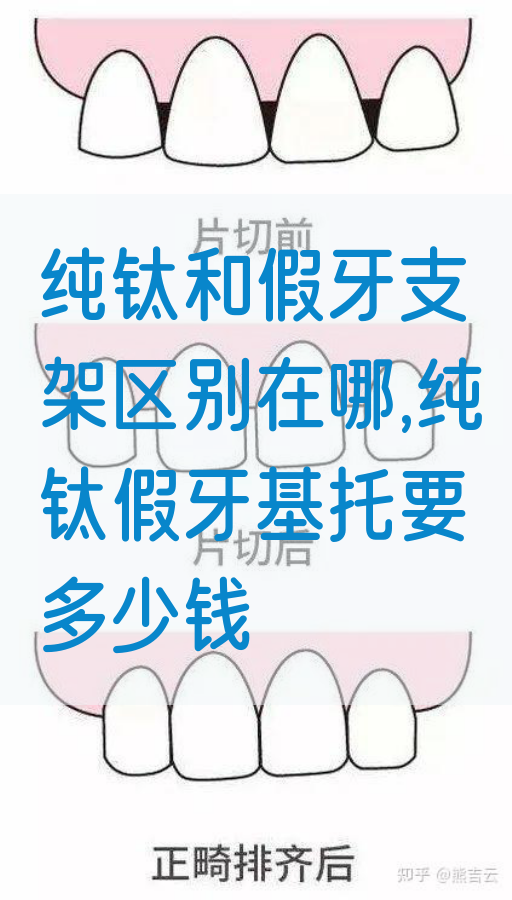 纯钛和假牙支架区别在哪,纯钛假牙基托要多少钱
