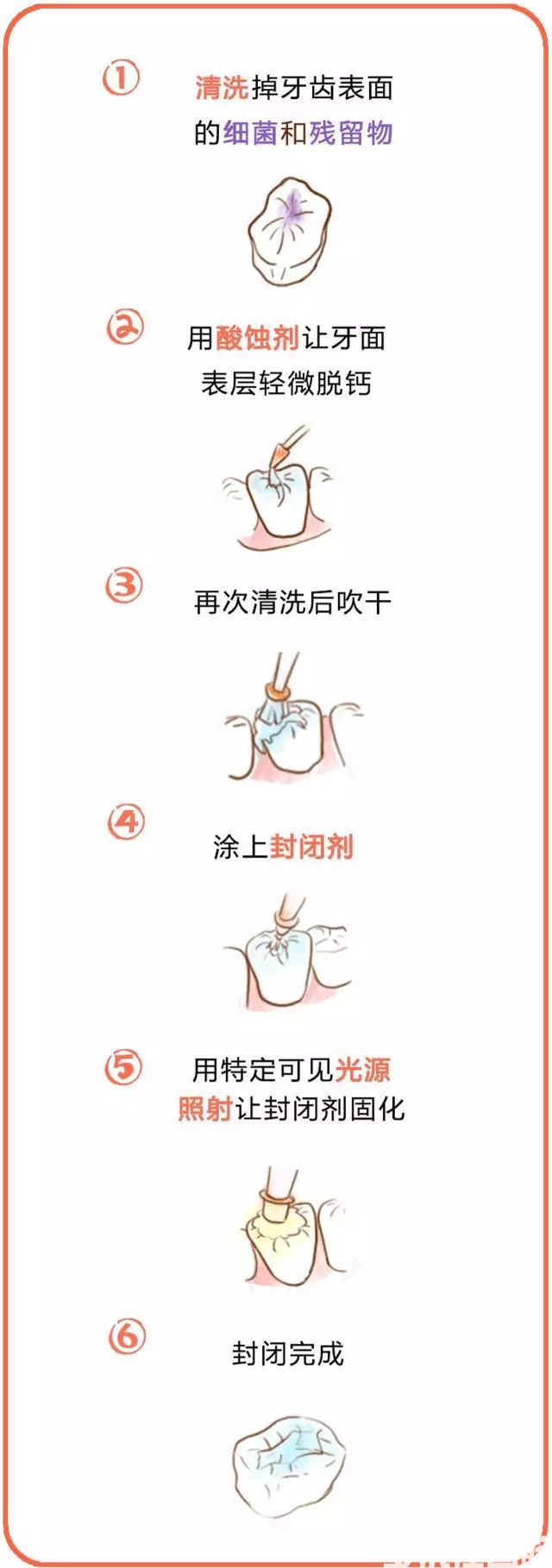 牙齿涂氟、窝沟封闭，究竟是什么？(图12)