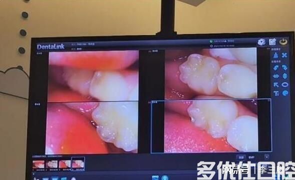 “牙齿涂氟”对孩子有没有副作用？“窝沟封闭”到底要不要做？(图3)