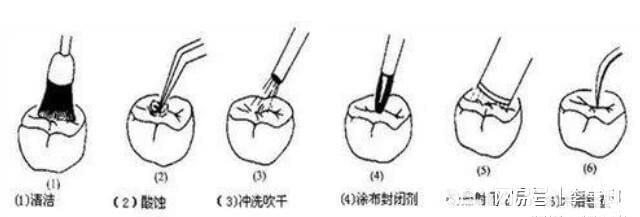 “牙齿涂氟”对孩子有没有副作用？“窝沟封闭”到底要不要做？(图7)