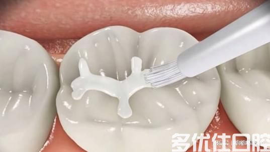 孩子蛀牙后才知道牙齿涂氟的重要性！(图3)