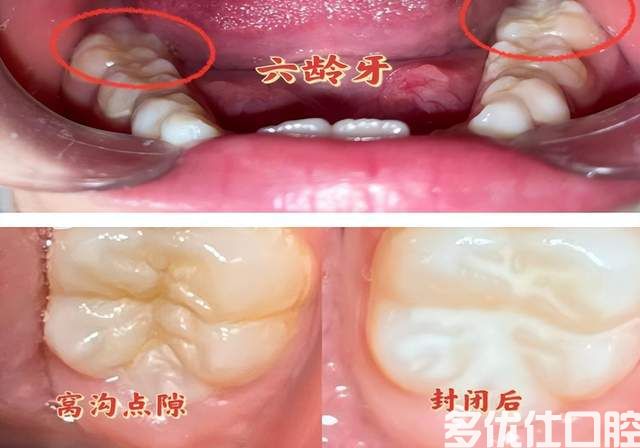 预防蛀牙，窝沟封闭有必要！为孩子的牙齿穿上“保护衣”(图1)
