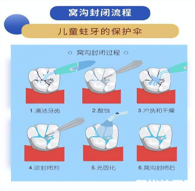 预防蛀牙，窝沟封闭有必要！为孩子的牙齿穿上“保护衣”(图2)